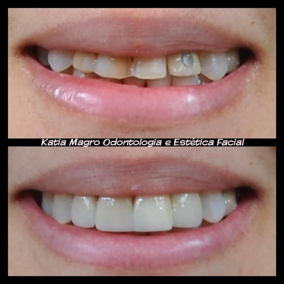 Facetas em Resina (antes e depois)